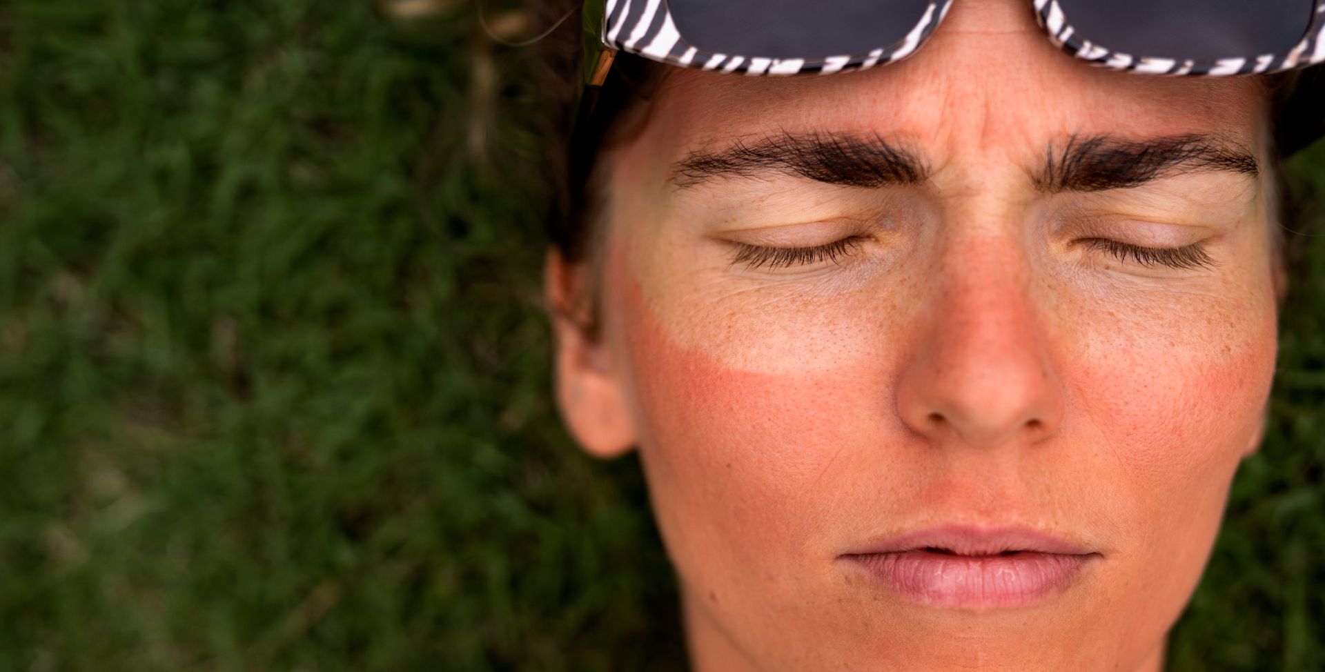 Ein Sonnenbrand erhöht den oxidativen Stress und die Menge freier Radikale.