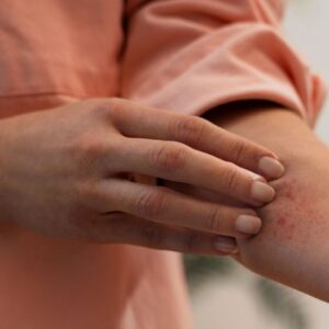 Ekzem: Ursachen, Symptome und Behandlung
