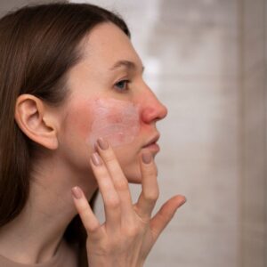 Rosazea: Ursachen, Symptome und Behandlung