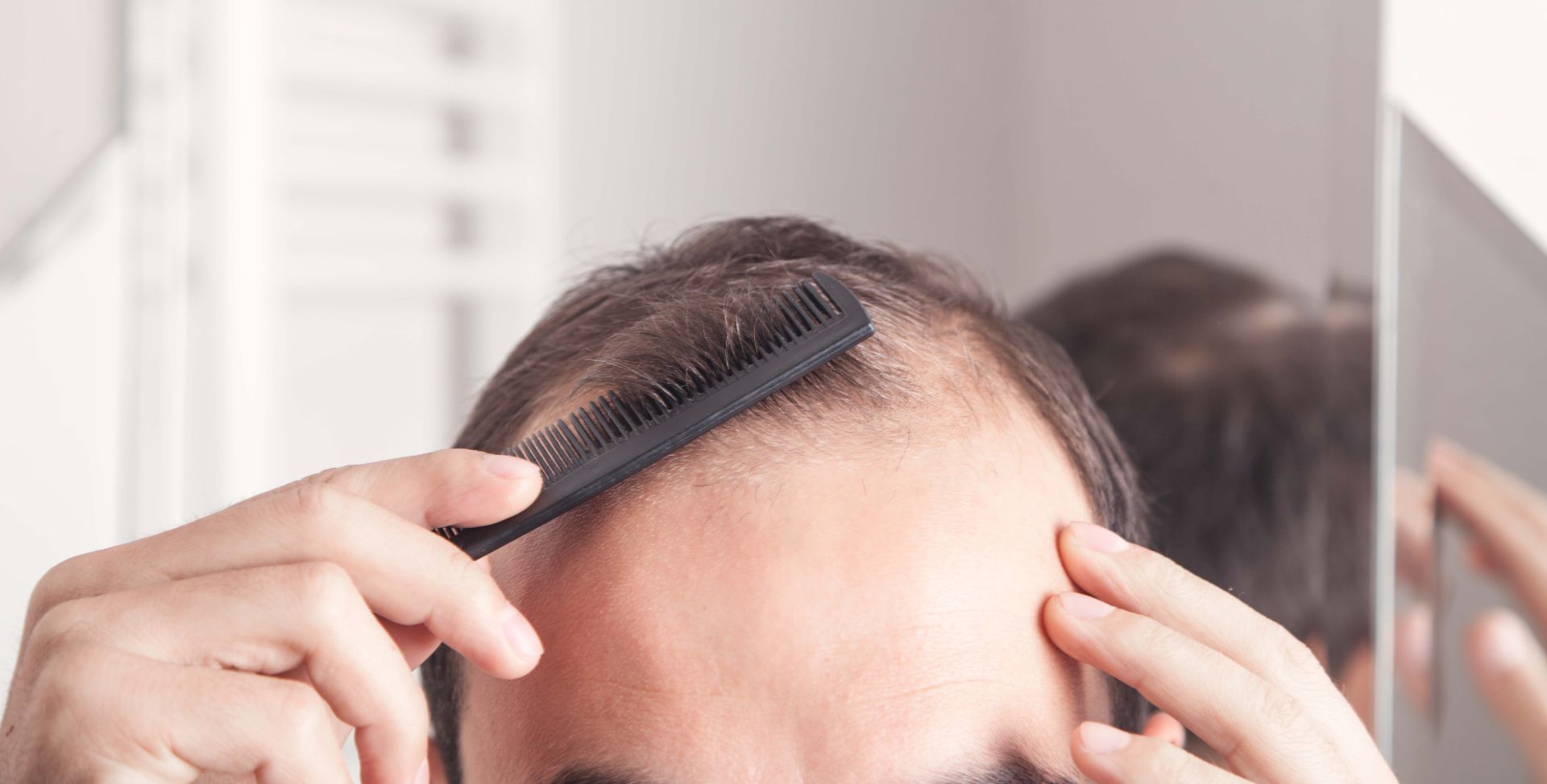 Ein Mann mit kahlen Stellen am Kopf. Es gibt verschiedene Gründe für Haarausfall.