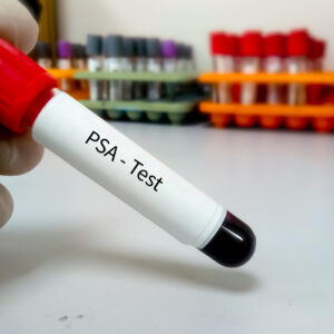 PSA-Wert: Normalwerte, Grenzen des PSA-Tests und Ursachen für erhöhte Werte