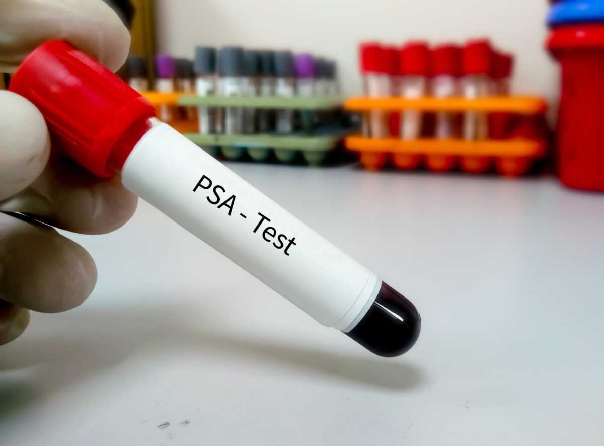 Ein Reagenzglas mit Blut für den PSA-Test, der den PSA-Wert bestimmt.